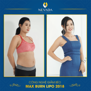  Review giảm béo Max Burn Lipo có đau không từ chuyên gia Mỹ Giam-beo-toan-than-cong-nghe-max-burn-lipo-co-dau-khong-09-300x300