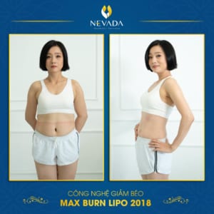 Review giảm béo Max Burn Lipo có đau không từ chuyên gia Mỹ Giam-beo-toan-than-cong-nghe-max-burn-lipo-co-dau-khong-1-300x300