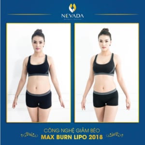  Review giảm béo Max Burn Lipo có đau không từ chuyên gia Mỹ Giam-beo-toan-than-cong-nghe-max-burn-lipo-co-dau-khong-23-300x300