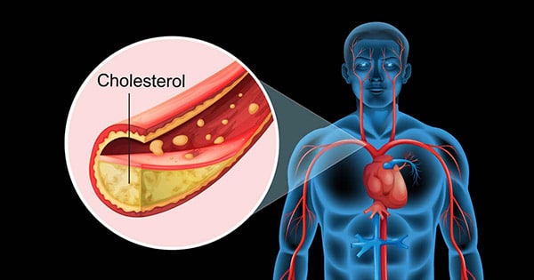 cholesterol là gì, cholesterol cao trong máu, cholesterol cao là gì, cholesterol toàn phần là gì