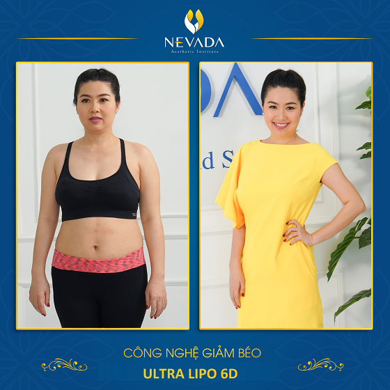 công nghệ giảm béo Ultra Lipo 6D siêu hủy mỡ giúp đánh tan mỡ thừa, giảm béo hiệu quả 6