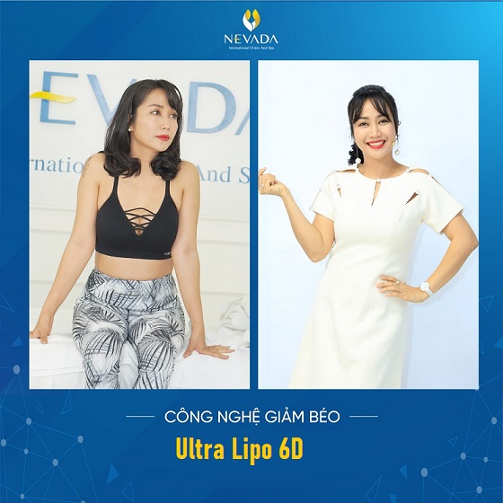 công nghệ giảm béo Ultra Lipo 6D siêu hủy mỡ giúp đánh tan mỡ thừa, giảm béo hiệu quả 4