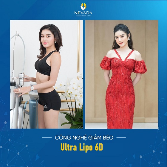 công nghệ giảm béo Ultra Lipo 6D siêu hủy mỡ giúp đánh tan mỡ thừa, giảm béo hiệu quả 2