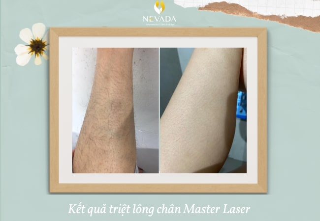 Quy trình triệt lông chân, Quy trình triệt lông chân vĩnh viễn, quy trình tẩy lông chân, liệu trình tẩy lông chân, liệu trình triệt lông chân