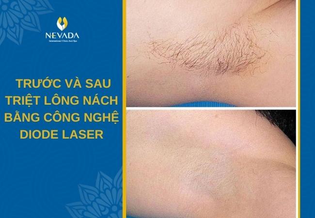 triệt lông nách bằng công nghệ diode laser là gì, triệt lông nách bằng laser có hại không, triệt lông nách vĩnh viễn bằng tia laser