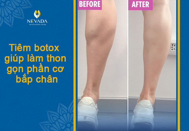 review tiêm botox tan mỡ thon gọn bắp chân có nguy hiểm không, giữ được bao lâu, có hại không, giá bao nhiêu