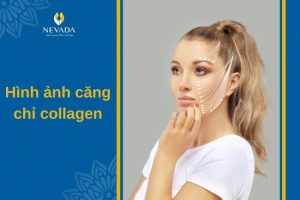 Cận cảnh hình ảnh căng chỉ collagen: Có nên căng chỉ da mặt hay không?