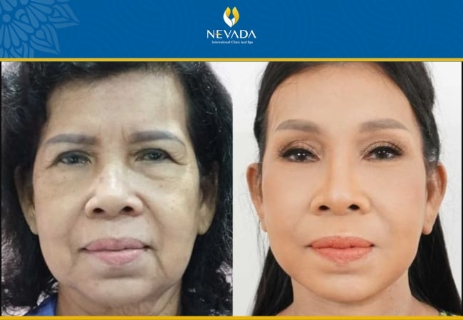 hình ảnh trước và sau khi căng da mặt, hình ảnh trước và sau khi căng chỉ da mặt, hình ảnh trước và sau khi căng da bụng