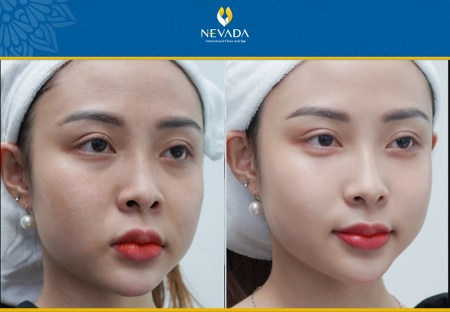hình ảnh trước và sau khi căng da mặt, hình ảnh trước và sau khi căng chỉ da mặt, hình ảnh trước và sau khi căng da bụng