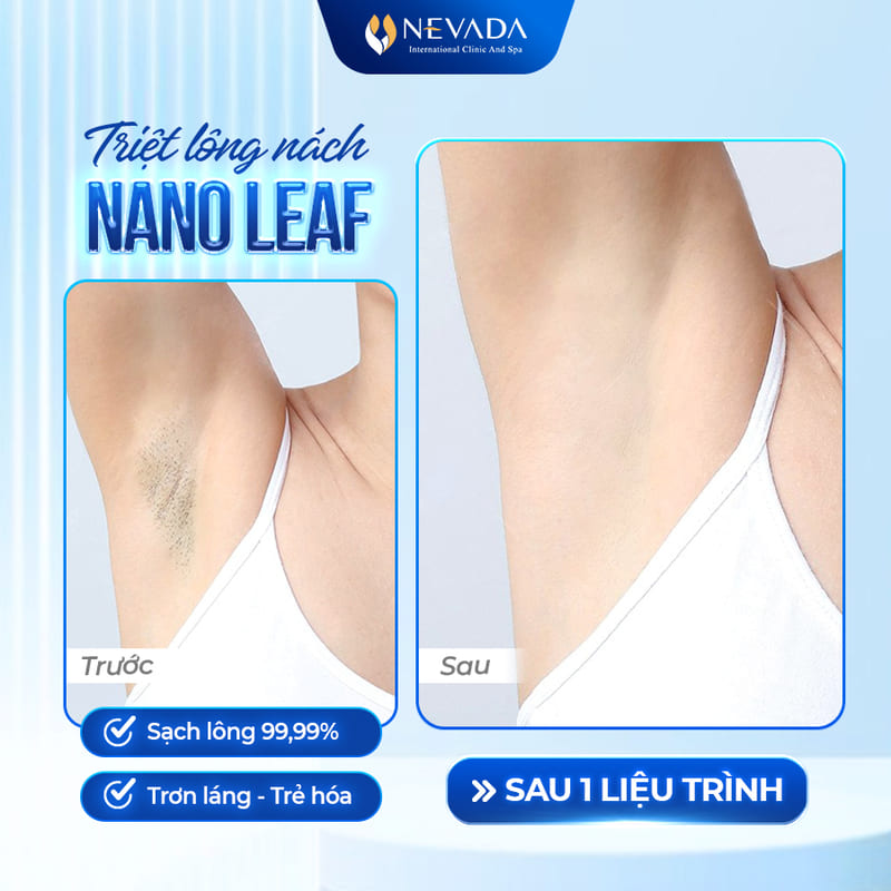 Công nghệ triệt lông Nano Leaf khuyến mãi khủng chỉ từ 99k